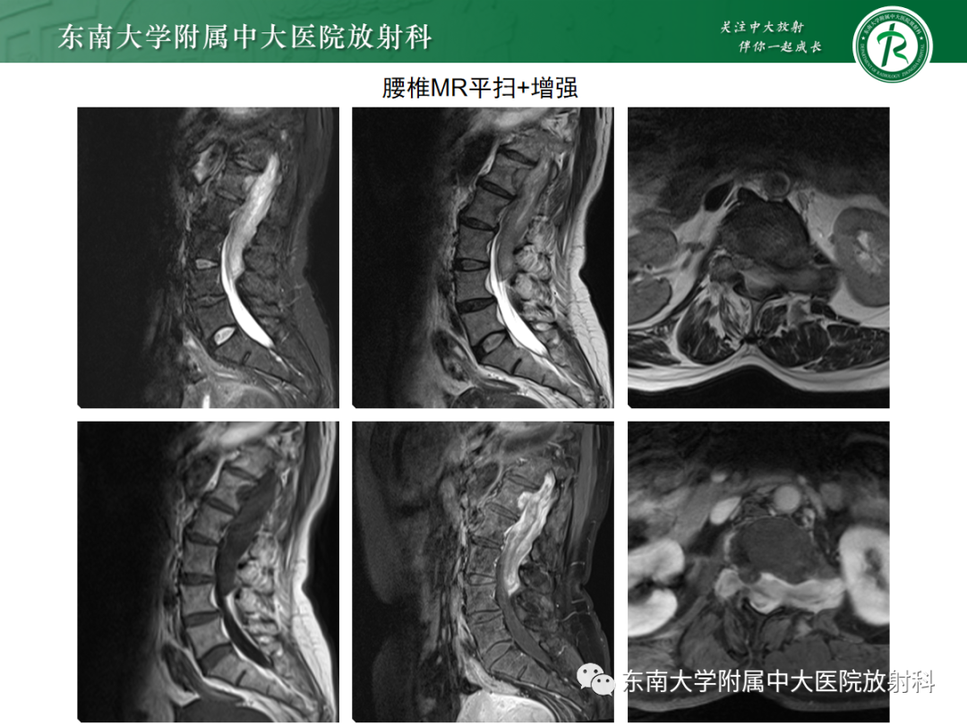 影像PPT - 【PPT】椎管内硬膜外间隙病变-5