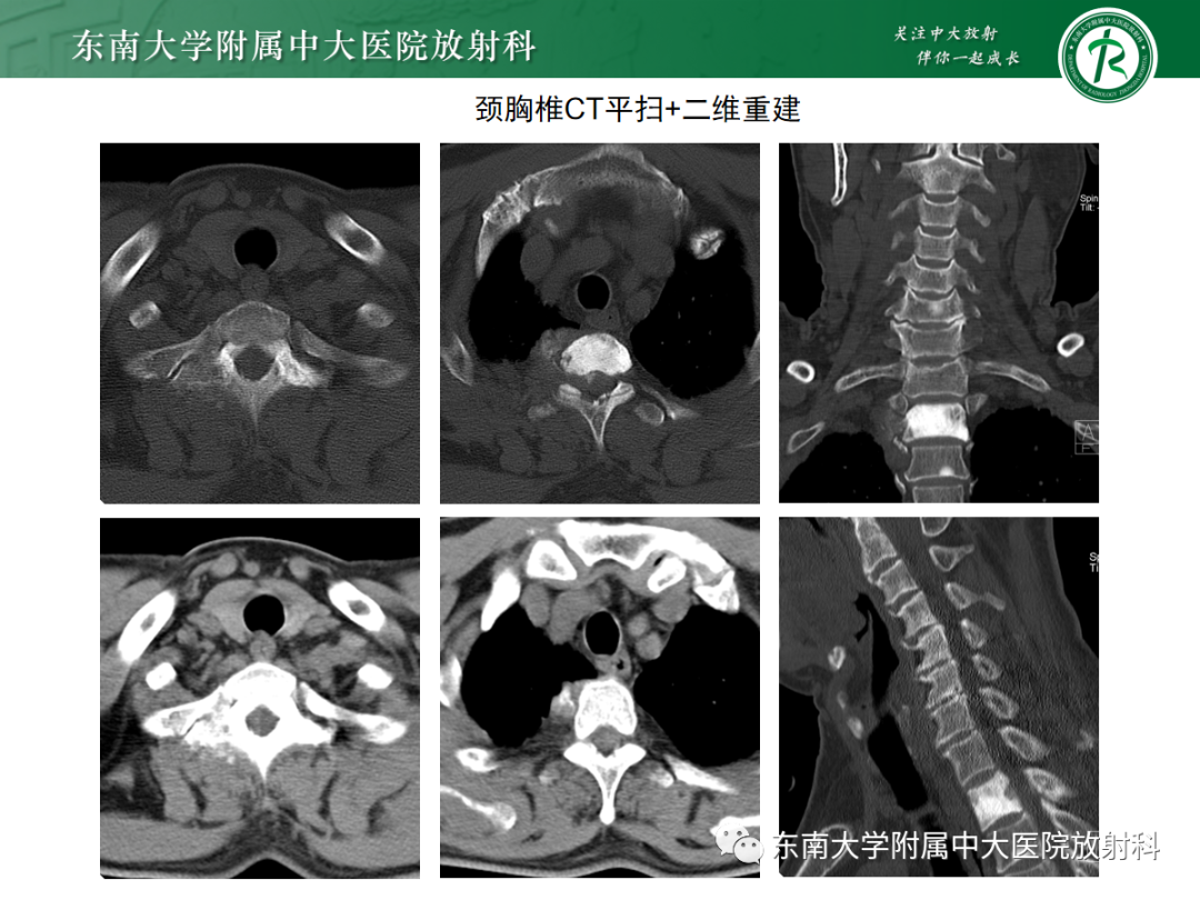 影像PPT - 【PPT】椎管内硬膜外间隙病变-7