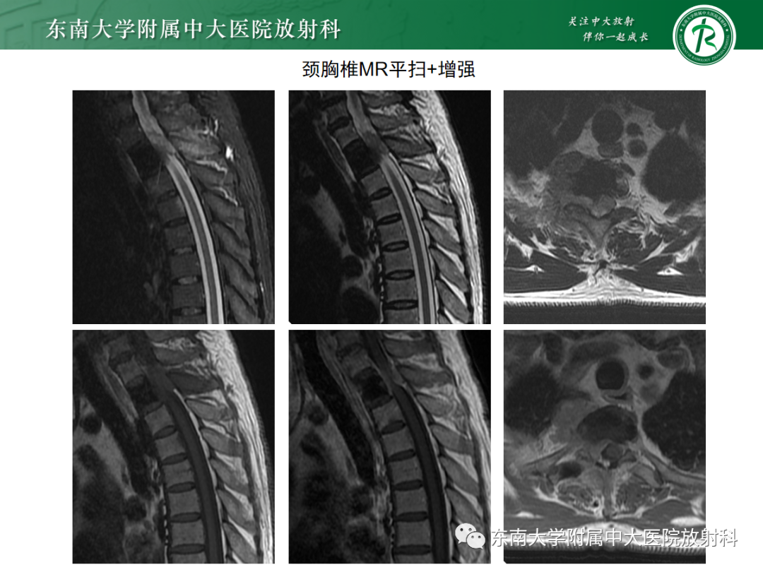影像PPT - 【PPT】椎管内硬膜外间隙病变-8