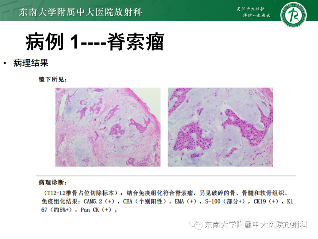 影像PPT - 【PPT】椎管内硬膜外间隙病变-11