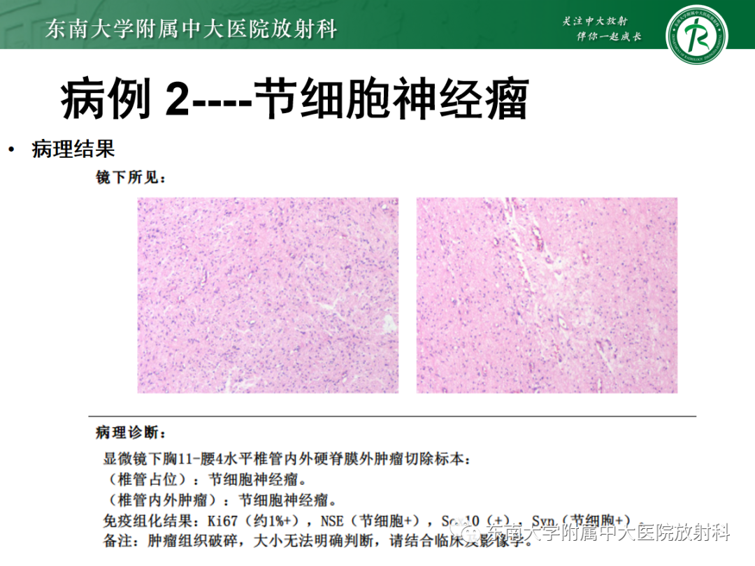 影像PPT - 【PPT】椎管内硬膜外间隙病变-12