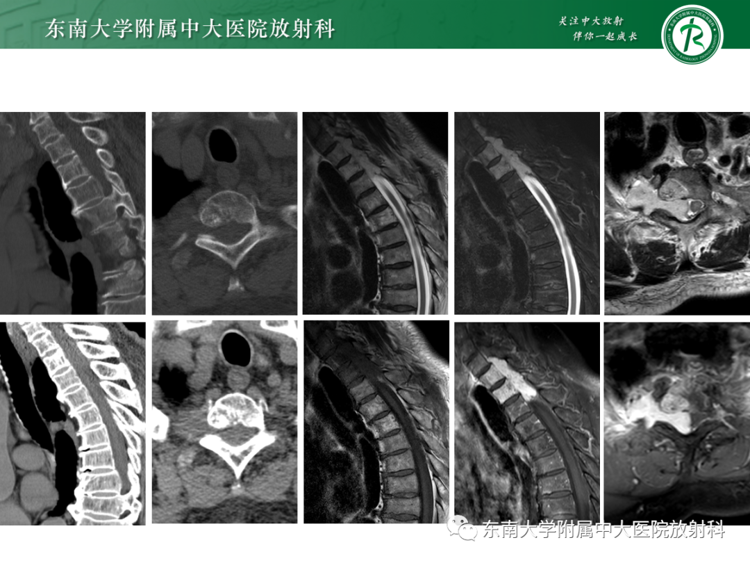 影像PPT - 【PPT】椎管内硬膜外间隙病变-10
