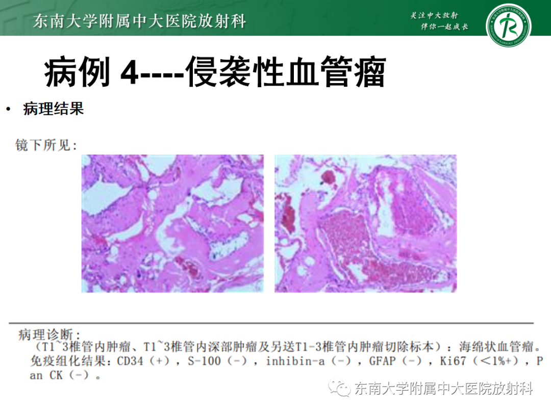 影像PPT - 【PPT】椎管内硬膜外间隙病变-14
