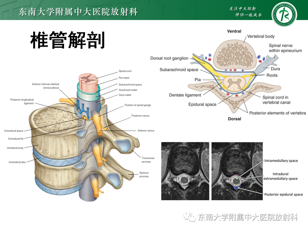 影像PPT - 【PPT】椎管内硬膜外间隙病变-20