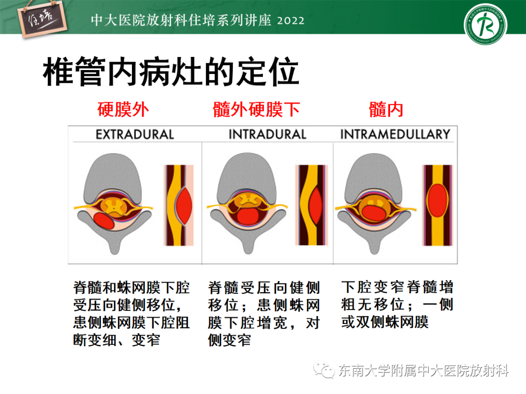 影像PPT - 【PPT】椎管内硬膜外间隙病变-22