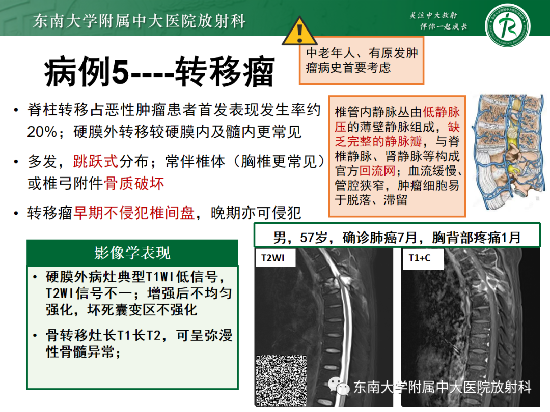 影像PPT - 【PPT】椎管内硬膜外间隙病变-25