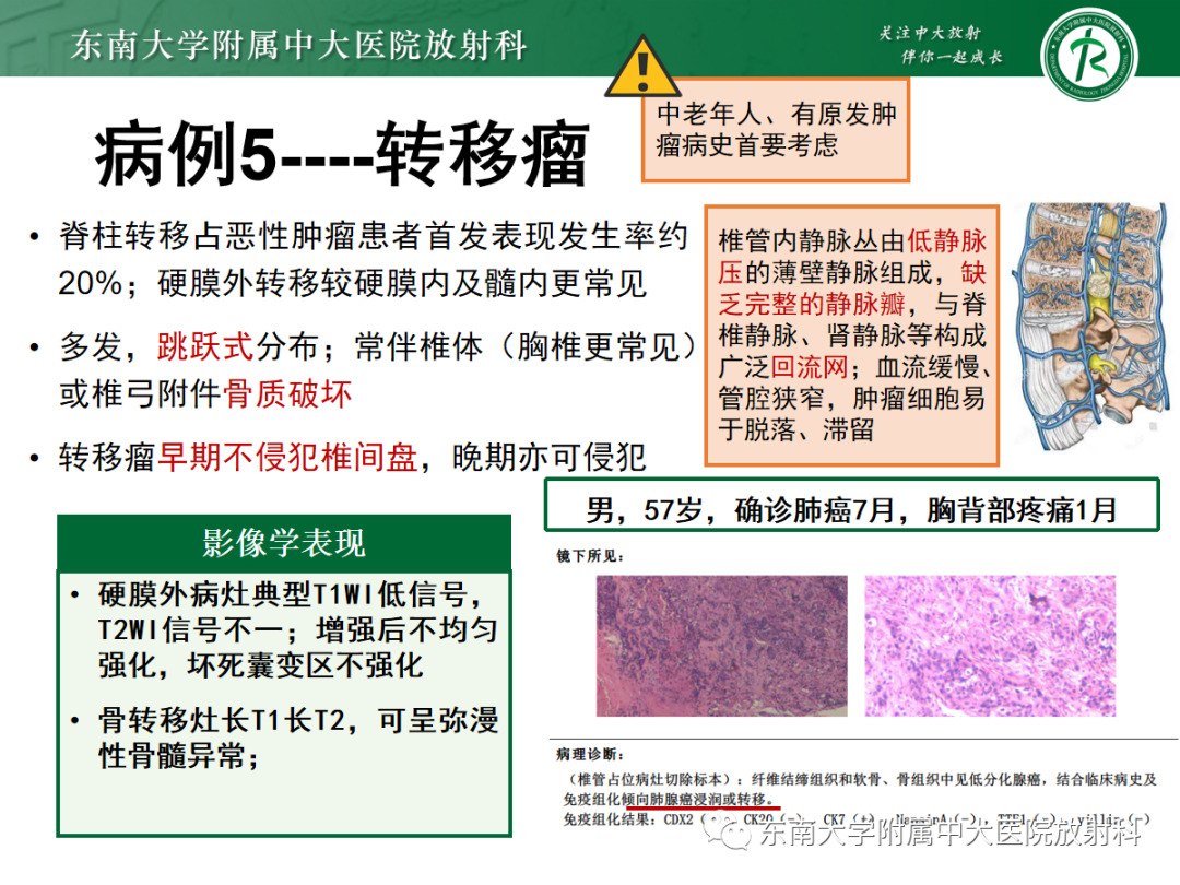 影像PPT - 【PPT】椎管内硬膜外间隙病变-26