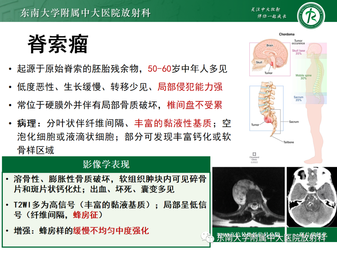 影像PPT - 【PPT】椎管内硬膜外间隙病变-27
