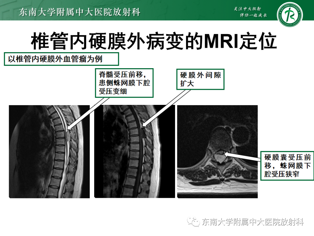 影像PPT - 【PPT】椎管内硬膜外间隙病变-23