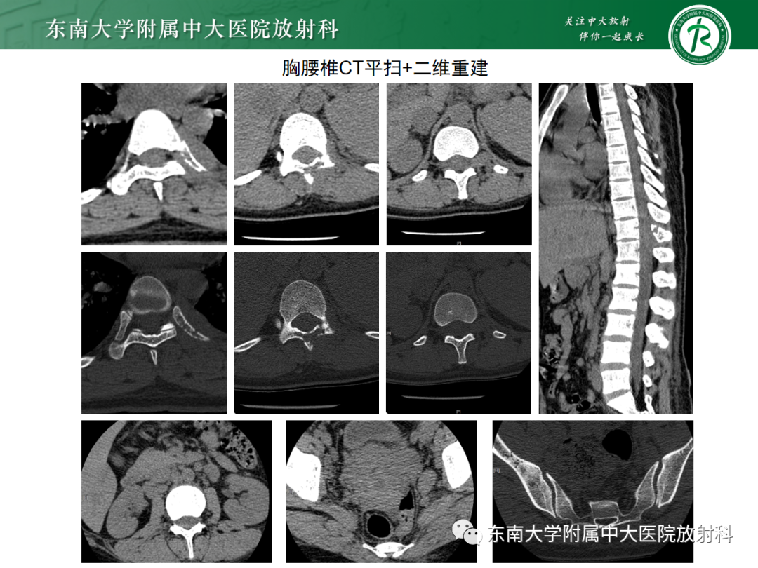影像PPT - 【PPT】椎管内硬膜外间隙病变-31