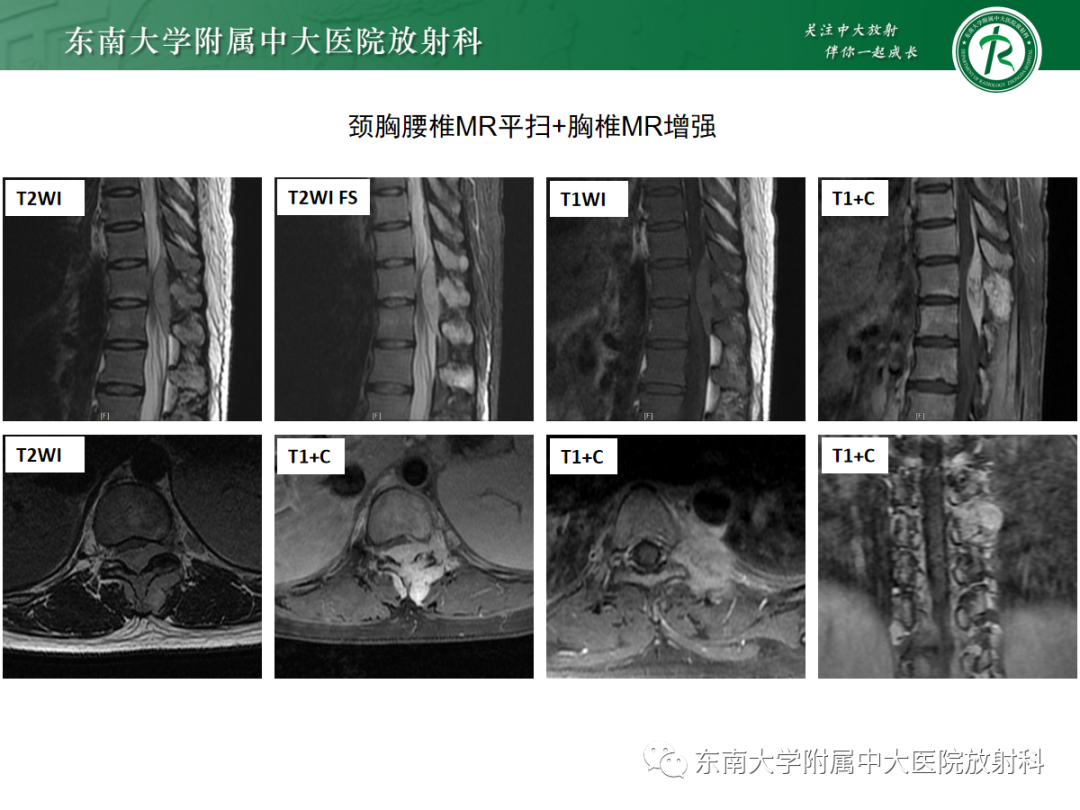 影像PPT - 【PPT】椎管内硬膜外间隙病变-32