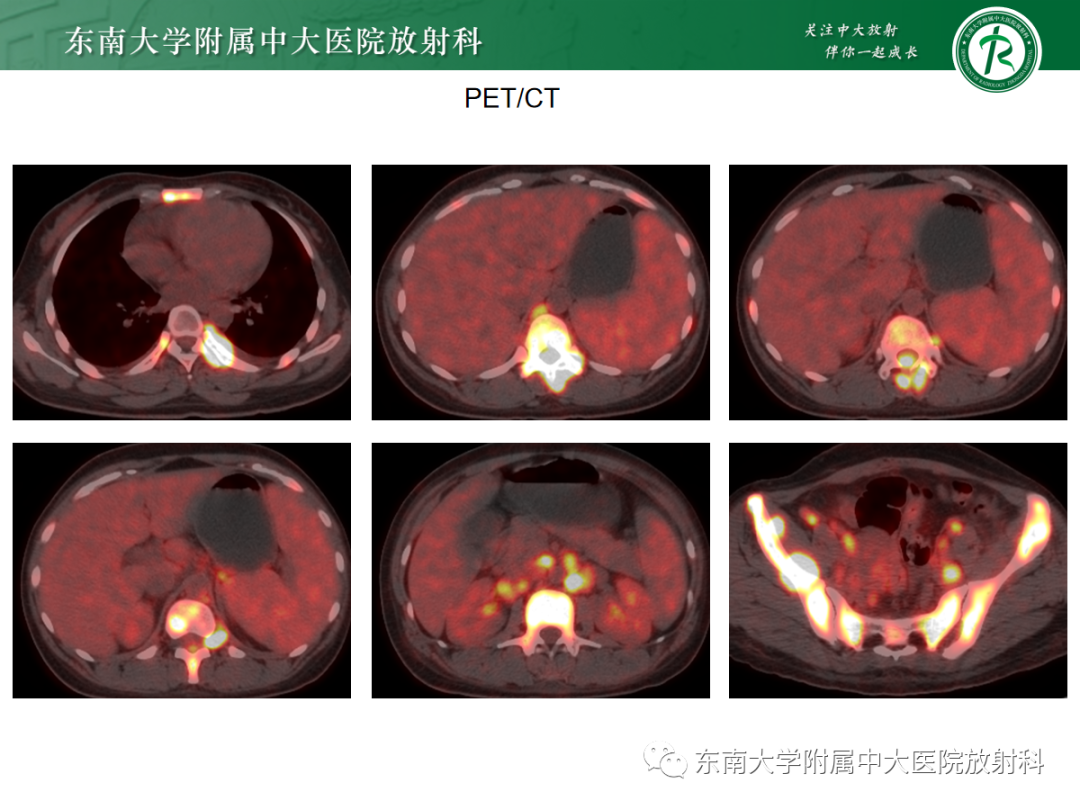 影像PPT - 【PPT】椎管内硬膜外间隙病变-34