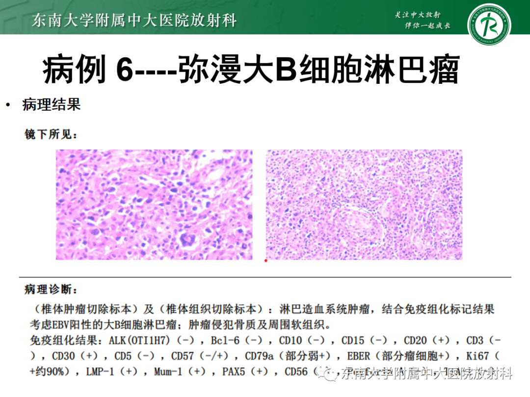 影像PPT - 【PPT】椎管内硬膜外间隙病变-35