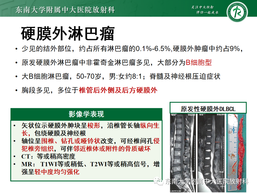 影像PPT - 【PPT】椎管内硬膜外间隙病变-36