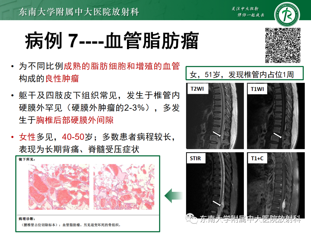 影像PPT - 【PPT】椎管内硬膜外间隙病变-37
