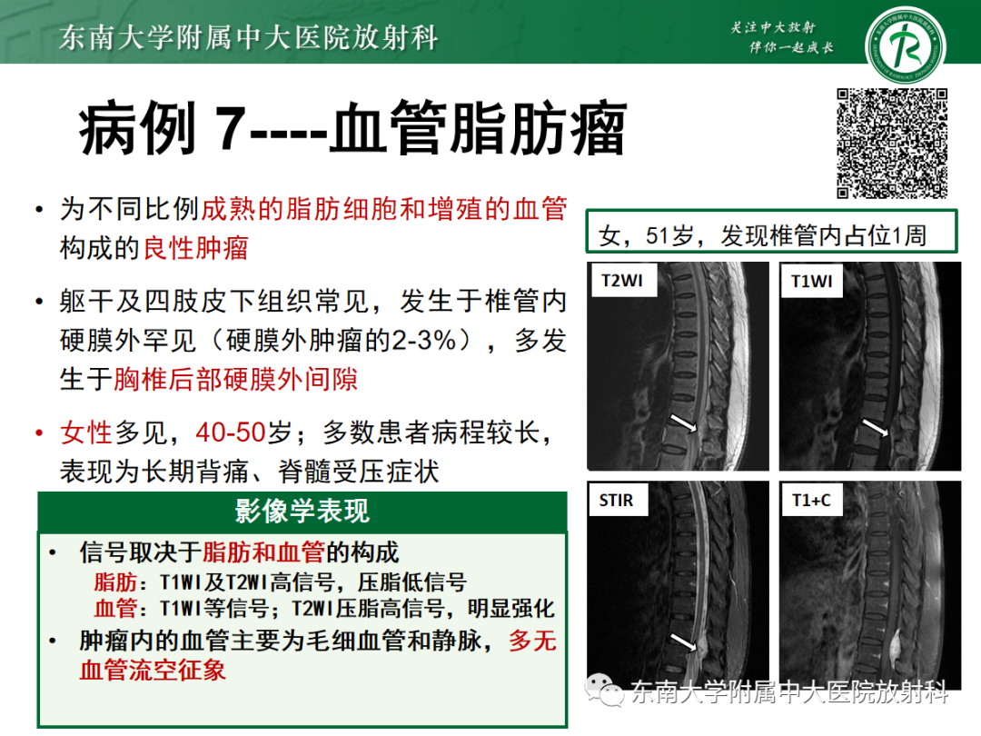 影像PPT - 【PPT】椎管内硬膜外间隙病变-38