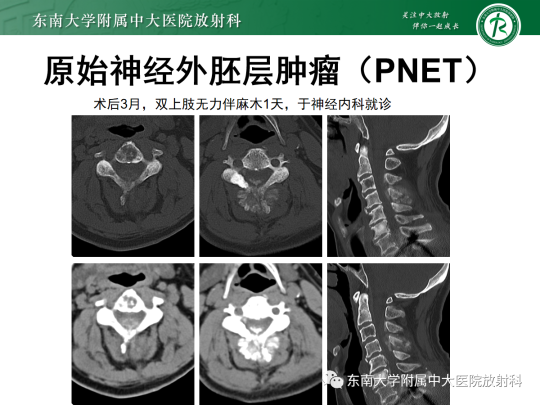 影像PPT - 【PPT】椎管内硬膜外间隙病变-41