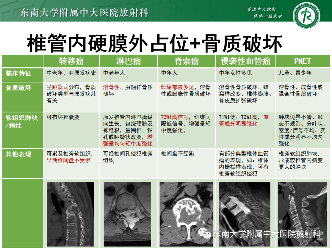 影像PPT - 【PPT】椎管内硬膜外间隙病变-43
