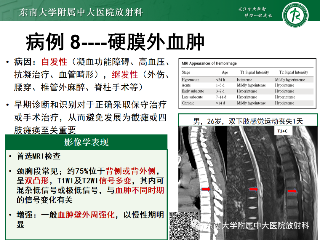 影像PPT - 【PPT】椎管内硬膜外间隙病变-44