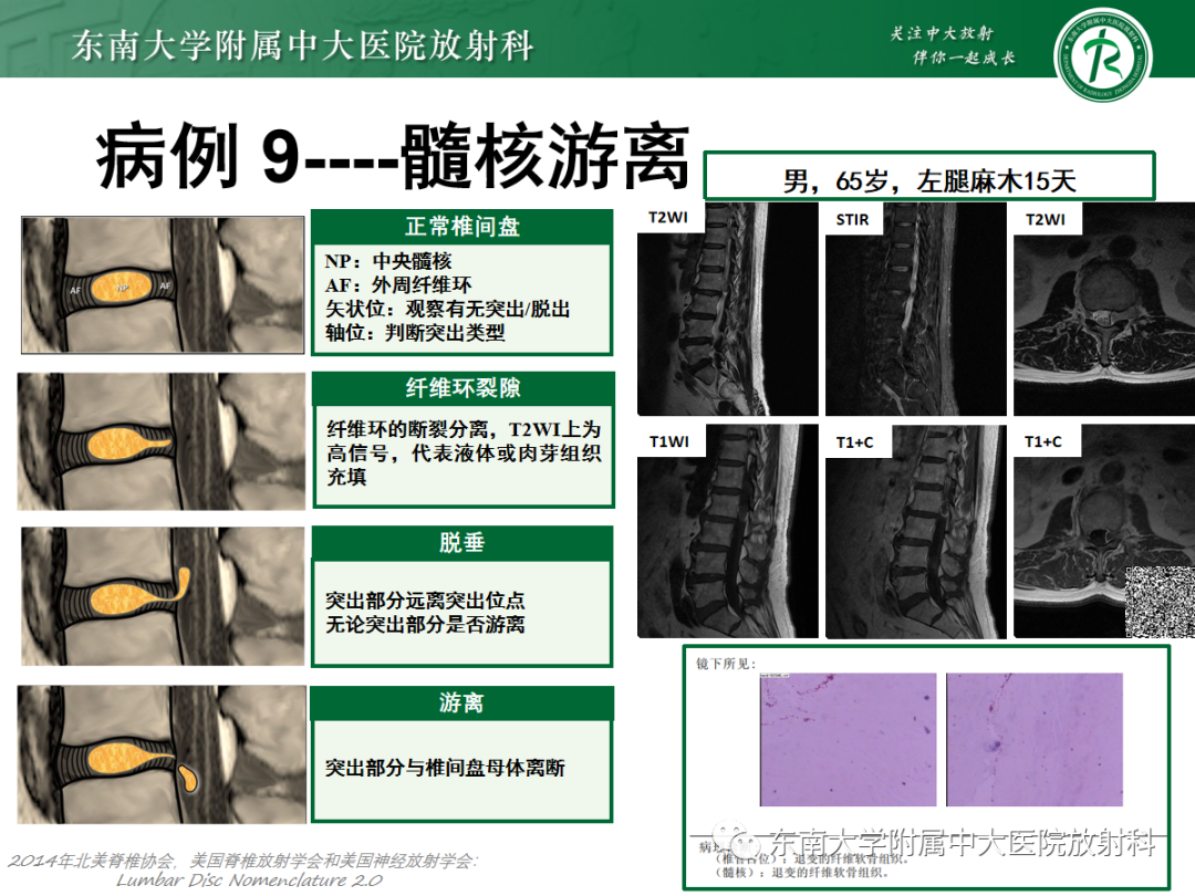 影像PPT - 【PPT】椎管内硬膜外间隙病变-45