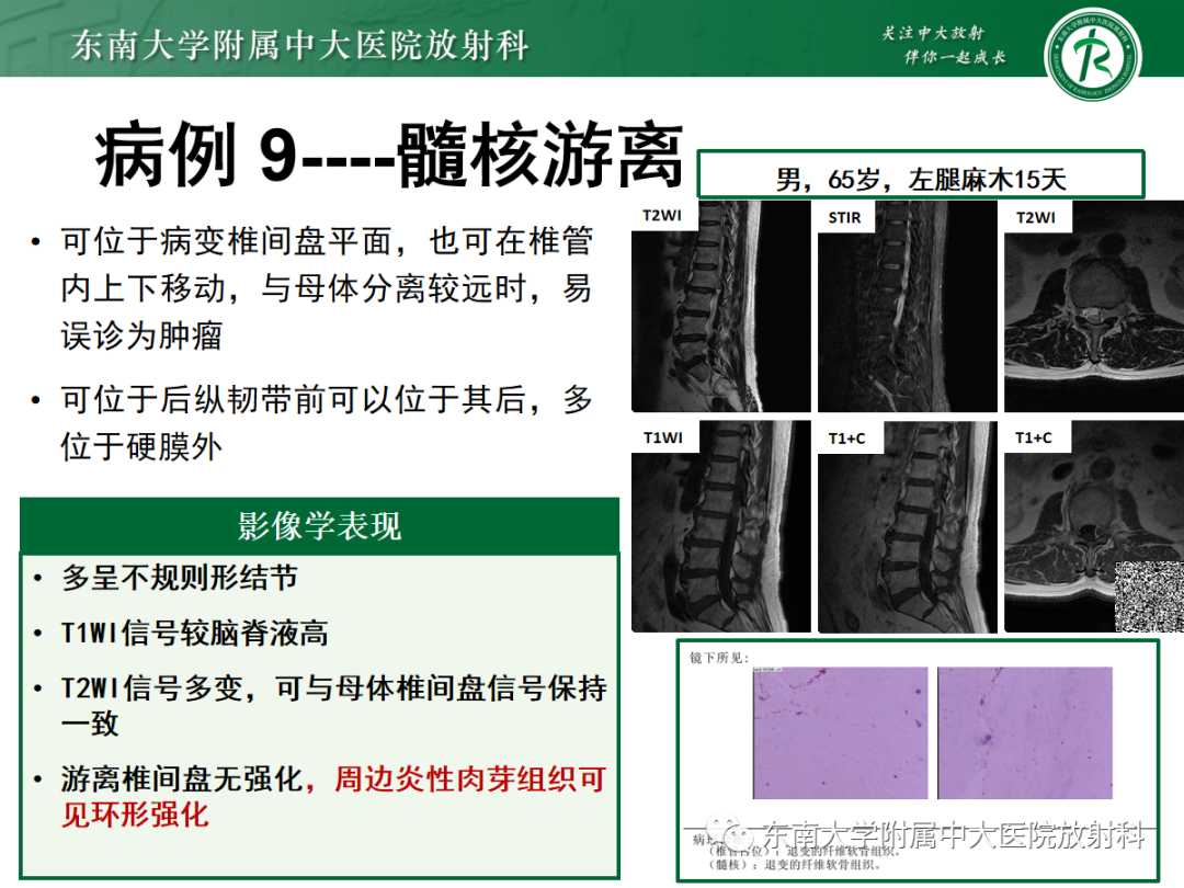 影像PPT - 【PPT】椎管内硬膜外间隙病变-46