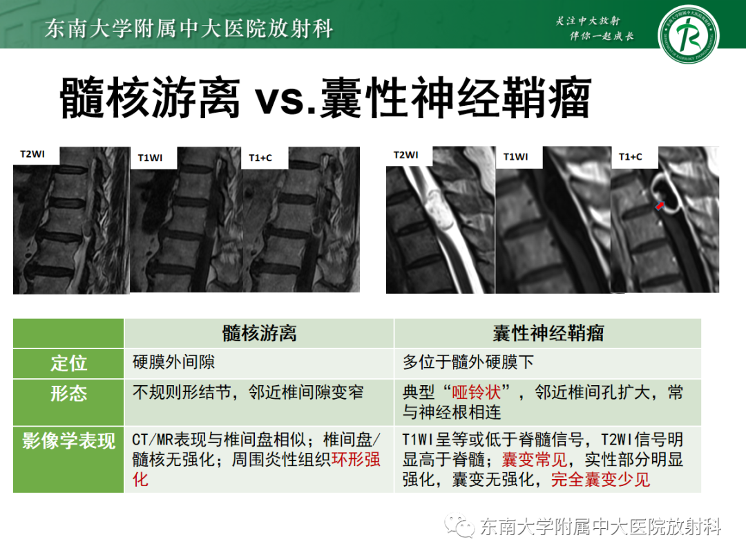 影像PPT - 【PPT】椎管内硬膜外间隙病变-47