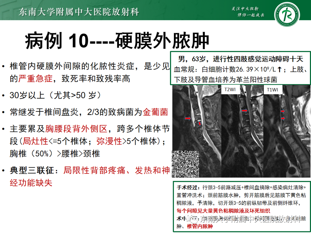 影像PPT - 【PPT】椎管内硬膜外间隙病变-49