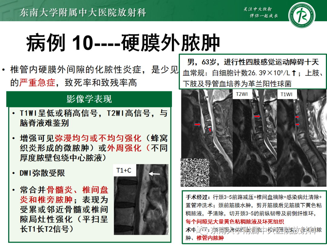 影像PPT - 【PPT】椎管内硬膜外间隙病变-50