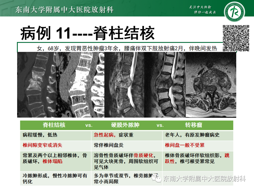 影像PPT - 【PPT】椎管内硬膜外间隙病变-52
