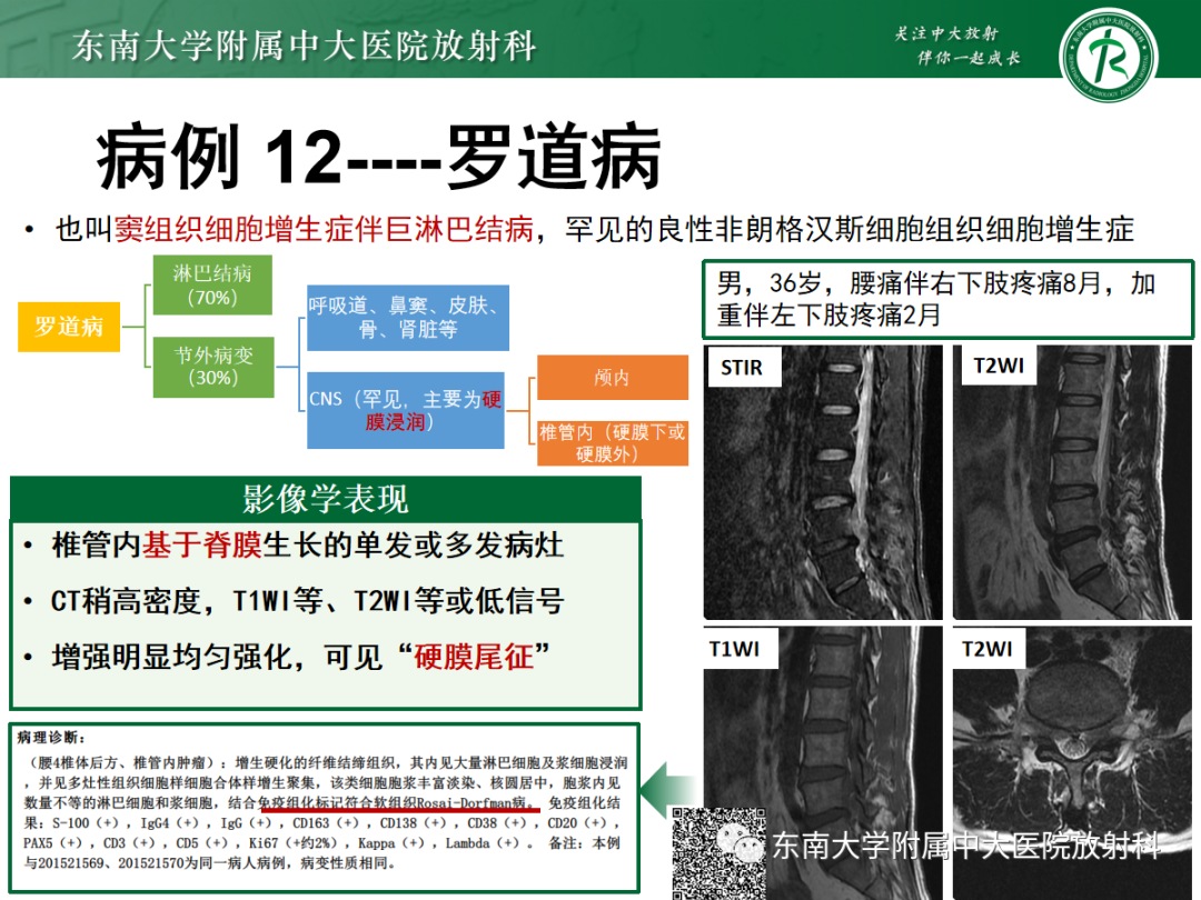 影像PPT - 【PPT】椎管内硬膜外间隙病变-53