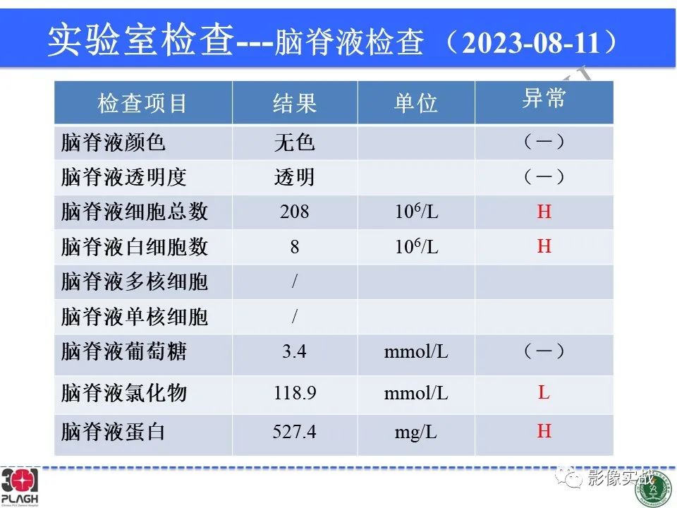 影像PPT - 【病例】髓鞘少突胶质细胞糖蛋白抗体相关疾病(MOG抗体相关疾病)-4