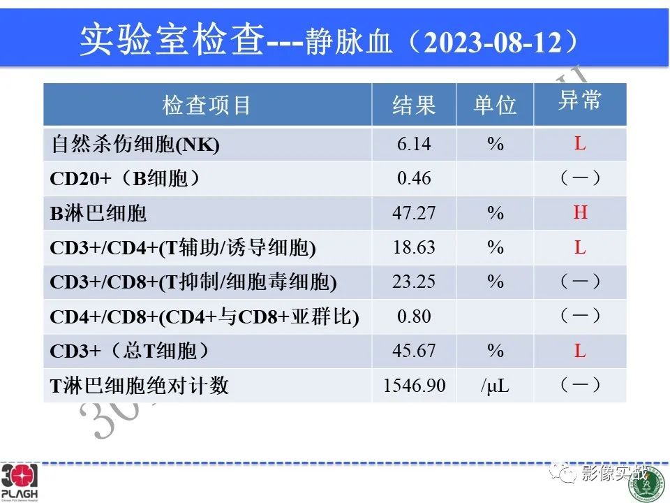 影像PPT - 【病例】髓鞘少突胶质细胞糖蛋白抗体相关疾病(MOG抗体相关疾病)-10