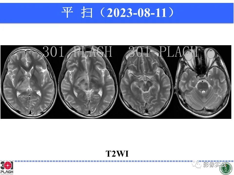 影像PPT - 【病例】髓鞘少突胶质细胞糖蛋白抗体相关疾病(MOG抗体相关疾病)-12