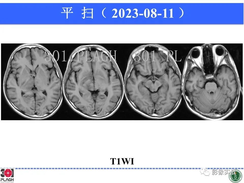 影像PPT - 【病例】髓鞘少突胶质细胞糖蛋白抗体相关疾病(MOG抗体相关疾病)-13