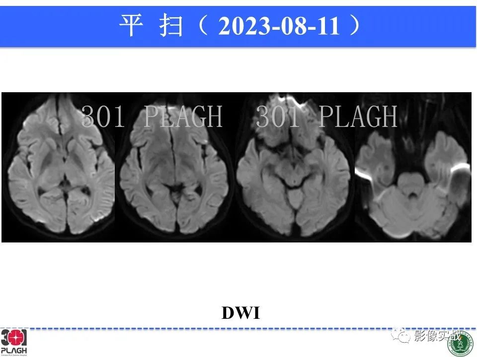 影像PPT - 【病例】髓鞘少突胶质细胞糖蛋白抗体相关疾病(MOG抗体相关疾病)-14