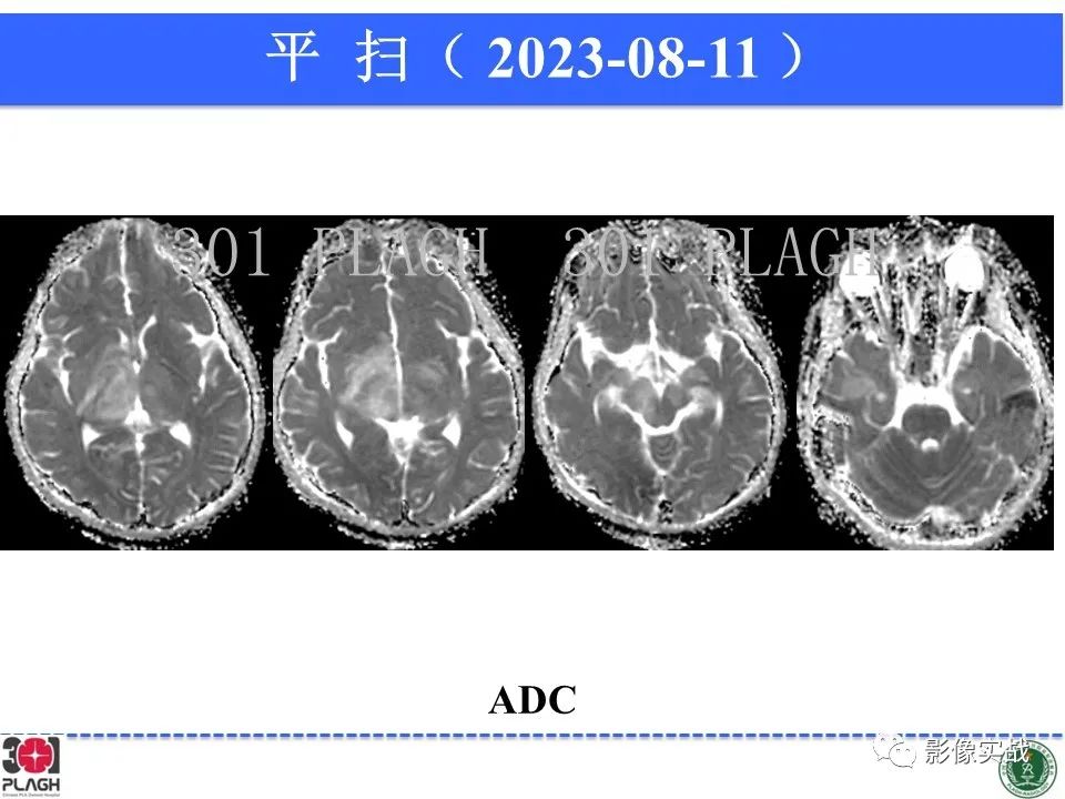 影像PPT - 【病例】髓鞘少突胶质细胞糖蛋白抗体相关疾病(MOG抗体相关疾病)-15