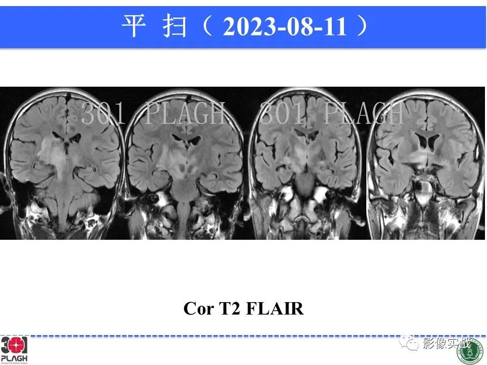 影像PPT - 【病例】髓鞘少突胶质细胞糖蛋白抗体相关疾病(MOG抗体相关疾病)-16