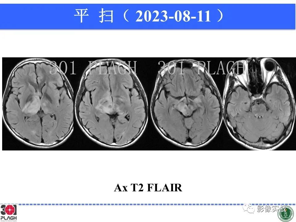 影像PPT - 【病例】髓鞘少突胶质细胞糖蛋白抗体相关疾病(MOG抗体相关疾病)-17