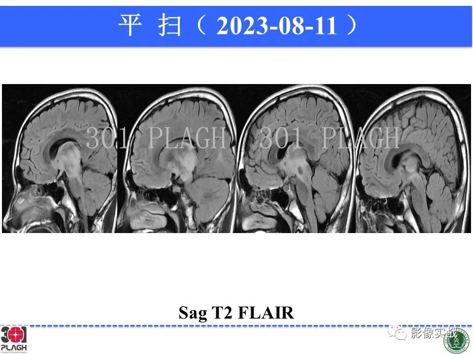 影像PPT - 【病例】髓鞘少突胶质细胞糖蛋白抗体相关疾病(MOG抗体相关疾病)-18