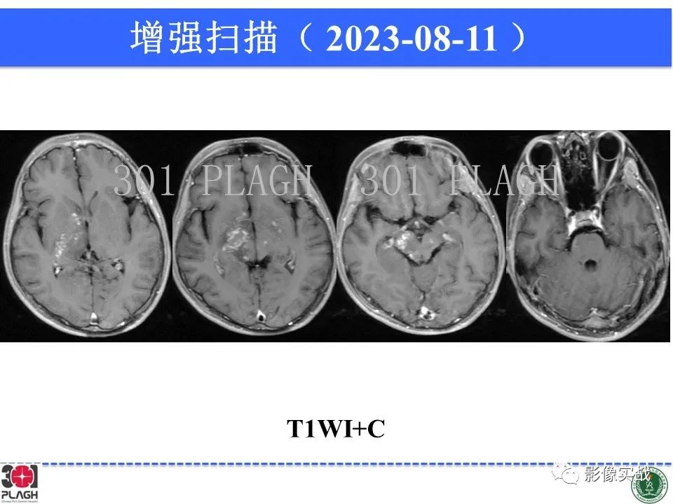 影像PPT - 【病例】髓鞘少突胶质细胞糖蛋白抗体相关疾病(MOG抗体相关疾病)-19