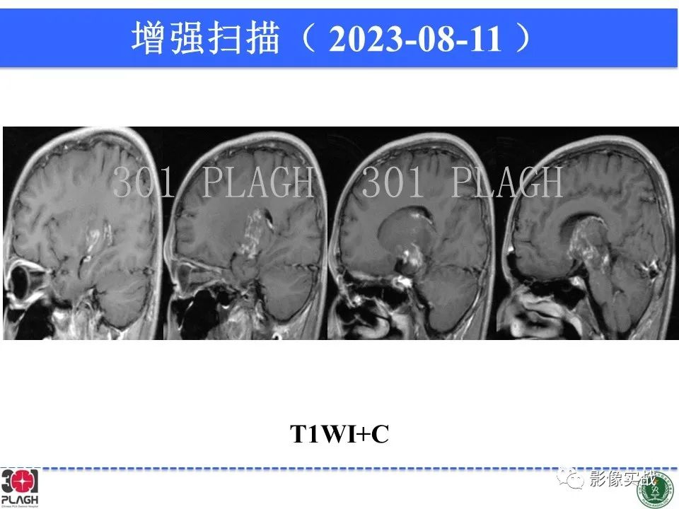 影像PPT - 【病例】髓鞘少突胶质细胞糖蛋白抗体相关疾病(MOG抗体相关疾病)-20