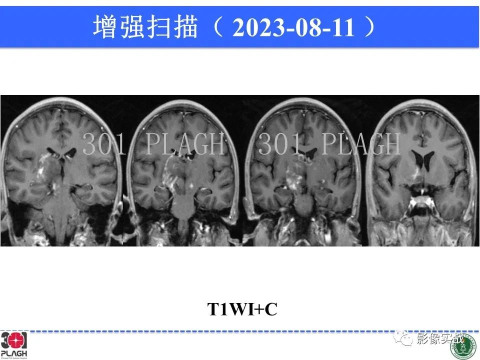 影像PPT - 【病例】髓鞘少突胶质细胞糖蛋白抗体相关疾病(MOG抗体相关疾病)-21