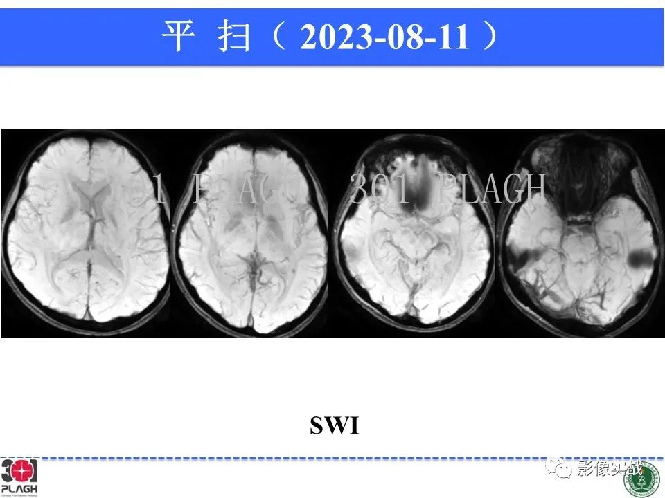 影像PPT - 【病例】髓鞘少突胶质细胞糖蛋白抗体相关疾病(MOG抗体相关疾病)-22