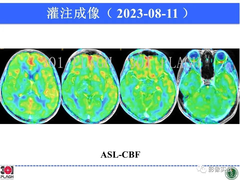 影像PPT - 【病例】髓鞘少突胶质细胞糖蛋白抗体相关疾病(MOG抗体相关疾病)-23