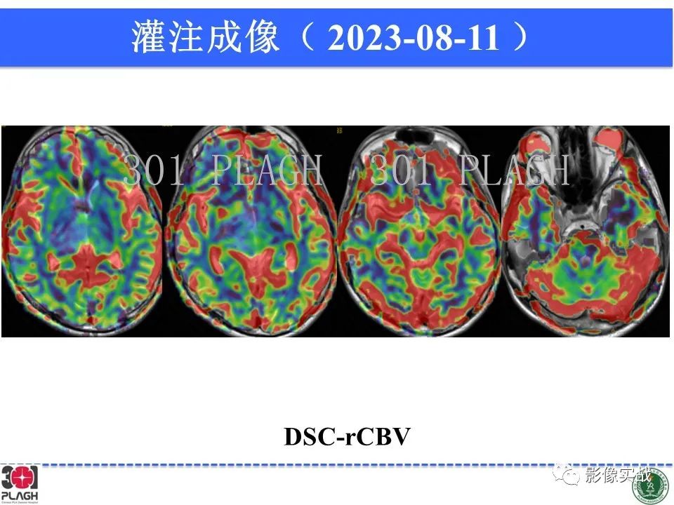 影像PPT - 【病例】髓鞘少突胶质细胞糖蛋白抗体相关疾病(MOG抗体相关疾病)-24