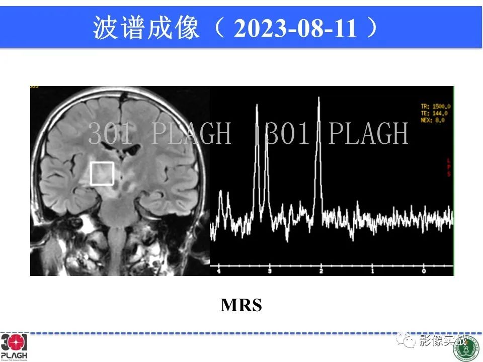 影像PPT - 【病例】髓鞘少突胶质细胞糖蛋白抗体相关疾病(MOG抗体相关疾病)-25