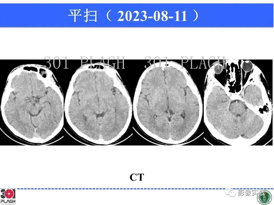 影像PPT - 【病例】髓鞘少突胶质细胞糖蛋白抗体相关疾病(MOG抗体相关疾病)-26