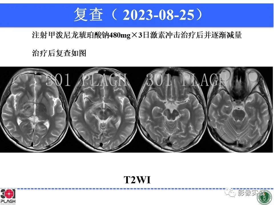 影像PPT - 【病例】髓鞘少突胶质细胞糖蛋白抗体相关疾病(MOG抗体相关疾病)-33