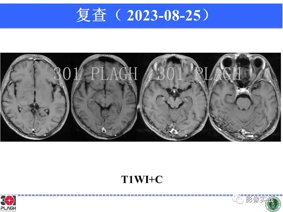 影像PPT - 【病例】髓鞘少突胶质细胞糖蛋白抗体相关疾病(MOG抗体相关疾病)-34