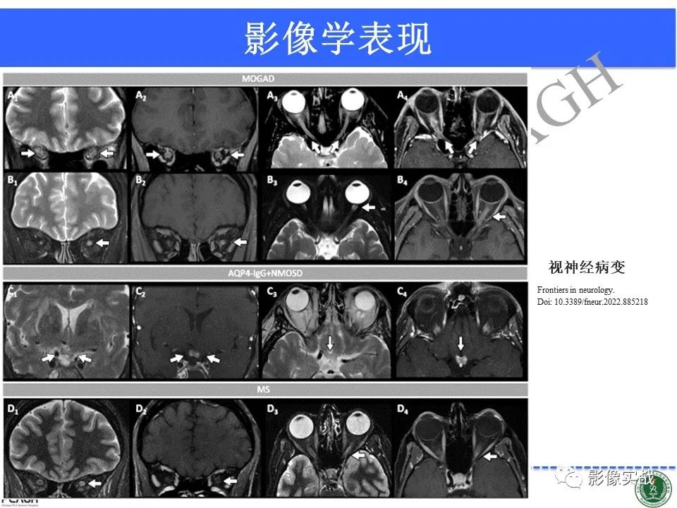 影像PPT - 【病例】髓鞘少突胶质细胞糖蛋白抗体相关疾病(MOG抗体相关疾病)-38